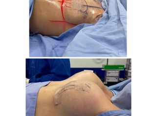 Mamoplastia de aumento - Dr. Zamir Páez