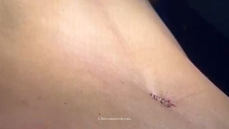 Lipoabdominoplastia`- Dr. Reinel Mesa
