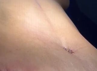 Lipoabdominoplastia`- Dr. Reinel Mesa