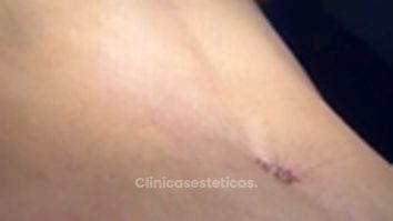 Lipoabdominoplastia`- Dr. Reinel Mesa