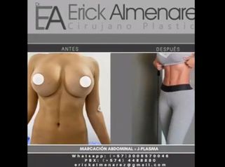Abdominoplastia 