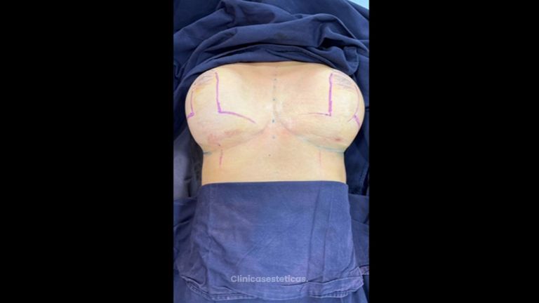 Mamoplastia de reducción - Dr. Raúl Daza