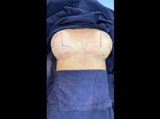 Mamoplastia de reducción - Dr. Raúl Daza