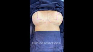 Mamoplastia de reducción - Dr. Raúl Daza