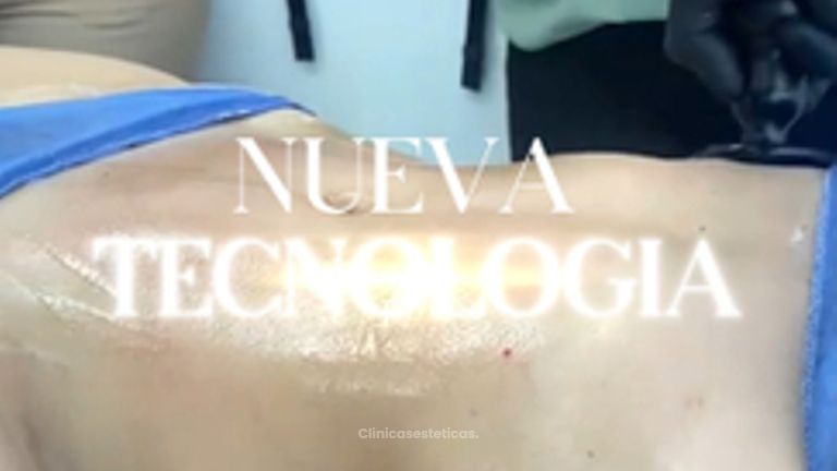 Eliminación de celulitis - Dra. Ángeles Esmeral