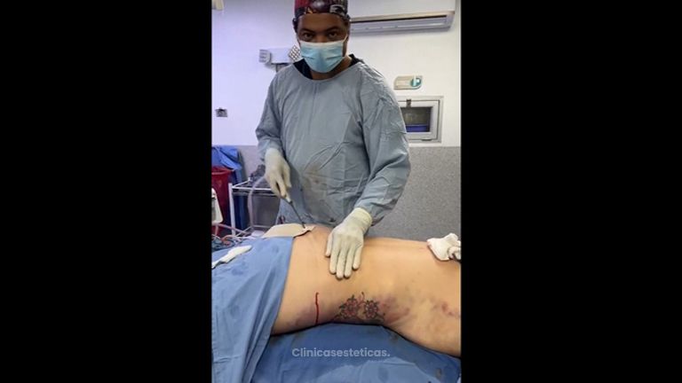Lipovaser en vivo - Dr. Jarold Effer Taylor