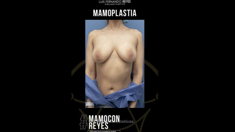 Mamoplastia de aumento - Dr. Luis Fernando Reyes
