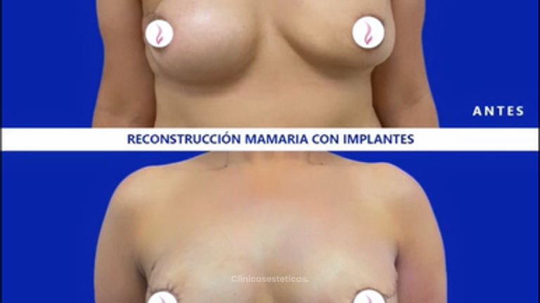 Reconstrucción mamaria antes y después. 