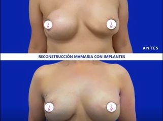 Reconstrucción mamaria antes y después. 