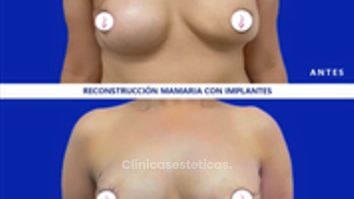Reconstrucción mamaria antes y después. 