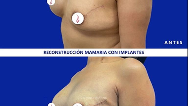 Reconstrucción mamaria antes y después. 