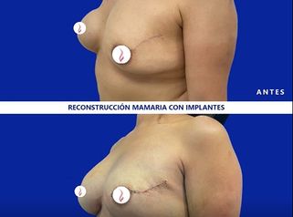 Reconstrucción mamaria antes y después. 