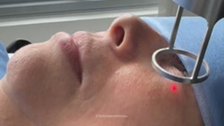 El LÁSER CO2 para rejuvenecimiento de párpados - Dra. Yulieth Figueroa Peñaranda