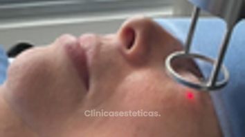 El LÁSER CO2 para rejuvenecimiento de párpados - Dra. Yulieth Figueroa Peñaranda