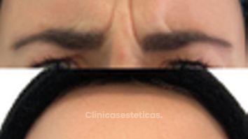 Toxina Botulínica - Doctora Alexandra Mora