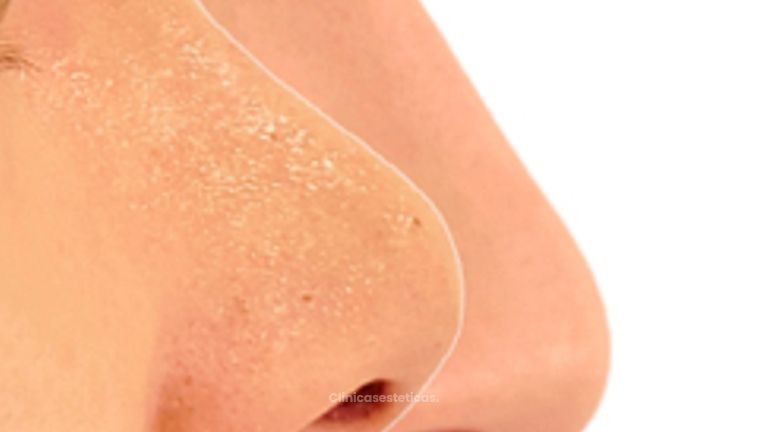 Rinoplastia - Doctora Alexandra Mora