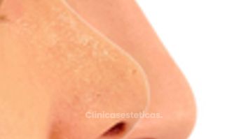 Rinoplastia - Doctora Alexandra Mora