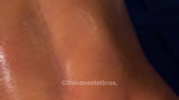 Lipoescultura HD - Clinica Vivir