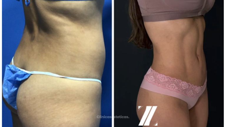 Liposucción - Dr. Zamir Páez