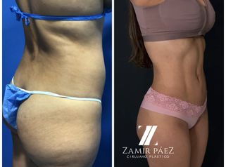 Liposucción - Dr. Zamir Páez