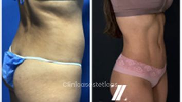 Liposucción - Dr. Zamir Páez