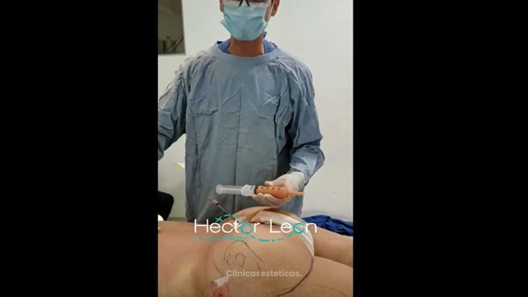 Gluteoplastia