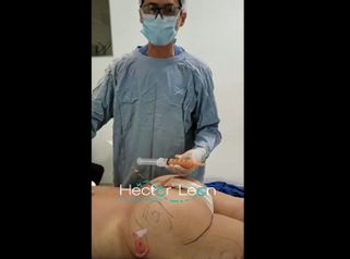 Gluteoplastia