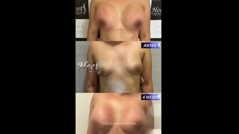 Mamoplastia de aumento - Dr. Jarold Effer Taylor