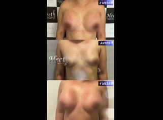 Mamoplastia de aumento - Dr. Jarold Effer Taylor
