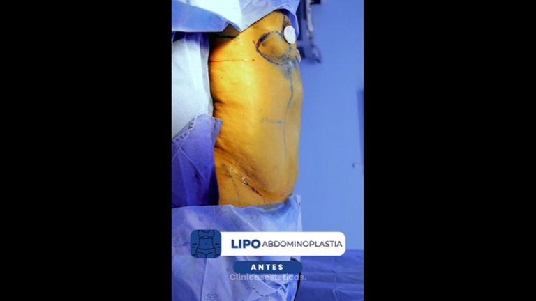 Lipoabdominoplastia - IDÉALISTE