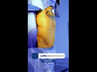 Lipoabdominoplastia - IDÉALISTE