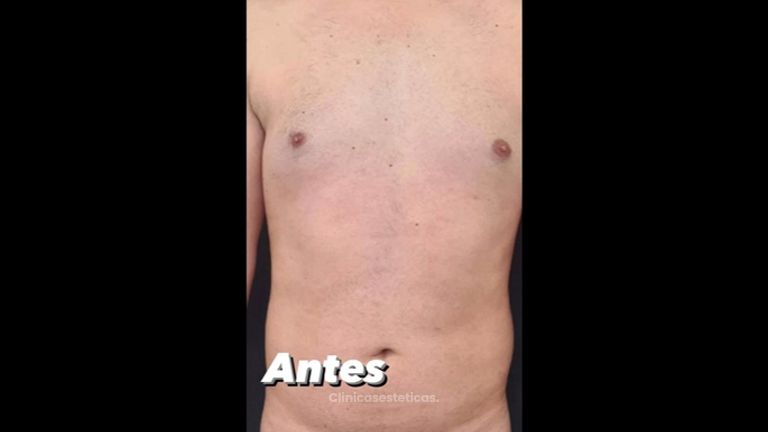 Abdominoplastia - Dra. Paola León