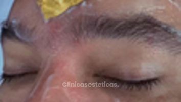 Rejuvenecimiento facial - Dr. Carlos Arturo Cervantes López