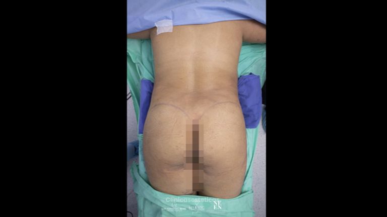 Gluteoplastia - Dr. Luis Fernando Reyes & Dra. Nicole Echeverry