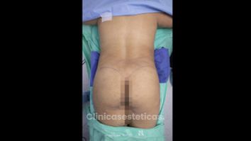 Gluteoplastia - Dr. Luis Fernando Reyes & Dra. Nicole Echeverry