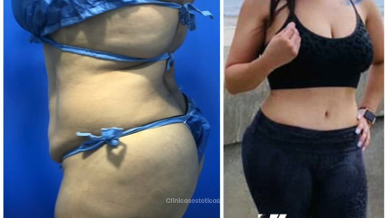 Abdominoplastia - Dr. Zamir Páez