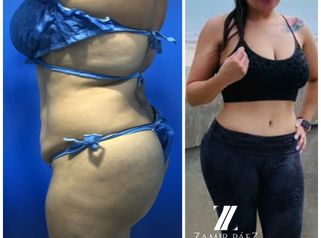 Abdominoplastia - Dr. Zamir Páez