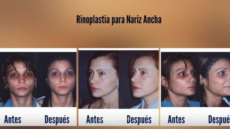 Rinoplastia para Nariz Ancha - Galería de Fotos antes y después.