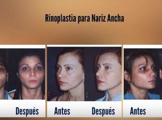 Rinoplastia para Nariz Ancha - Galería de Fotos antes y después.
