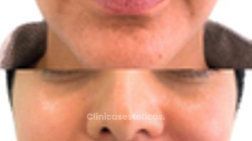 Bioestimuladores en Mejillas -Doctora Alexandra Mora