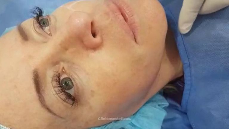 Doctor en procedimiento de rejuvenecimiento facial