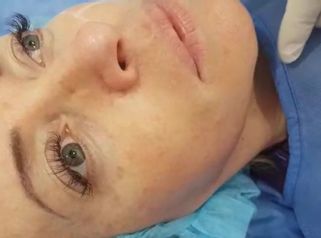 Doctor en procedimiento de rejuvenecimiento facial