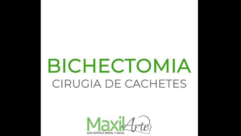 Bichectomia - Dr. Andrés Felipe Revelo Salamanca