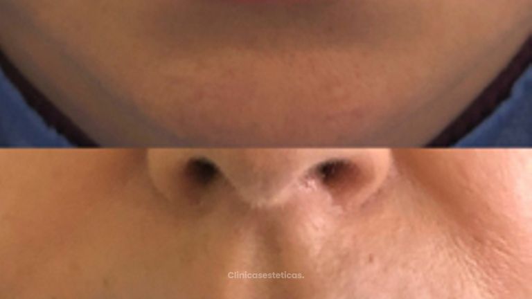Relleno de Labios - Doctora Alexandra Mora