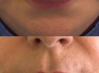 Relleno de Labios - Doctora Alexandra Mora