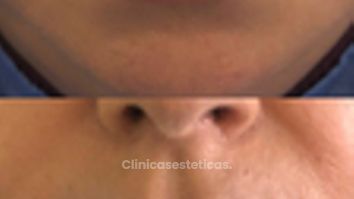 Relleno de Labios - Doctora Alexandra Mora