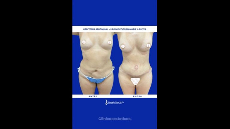 Liposucción - Dra. Daniela Stephania Vaca Grisales