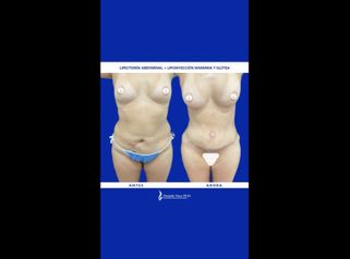 Liposucción - Dra. Daniela Stephania Vaca Grisales