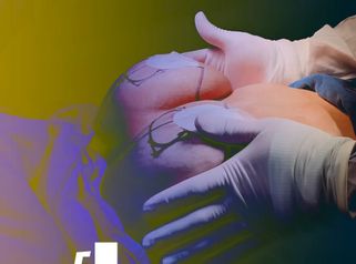 Explantacion mamaria - Dr. Jorge Puello White