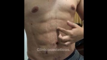 Marcación Abdominal 